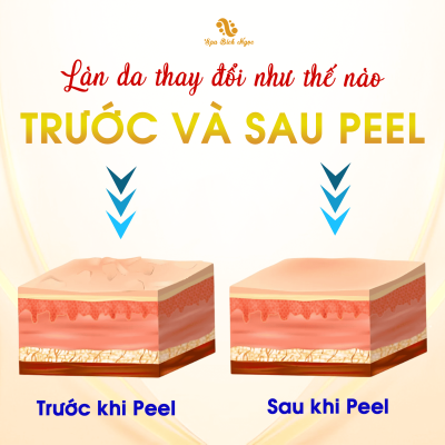 peel-da-spa-bich-ngoc-vinh-bao