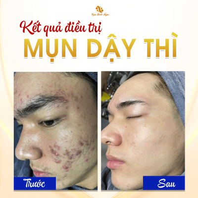 mun-spa-bich-ngoc-vinh-bao