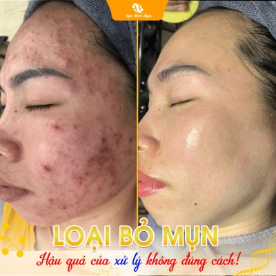 mun-spa-bich-ngoc-vinh-bao