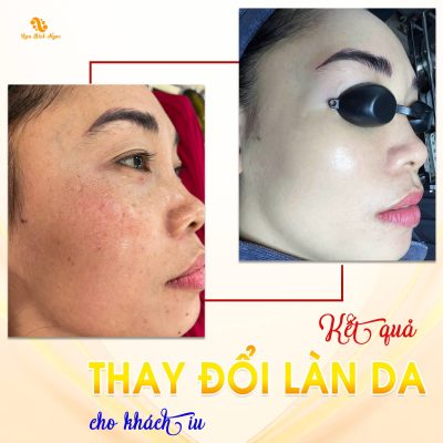 laser-picosure-spa-bich-ngoc