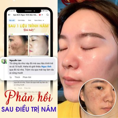 Tre-hoa-cacbon-spa-bich-ngoc