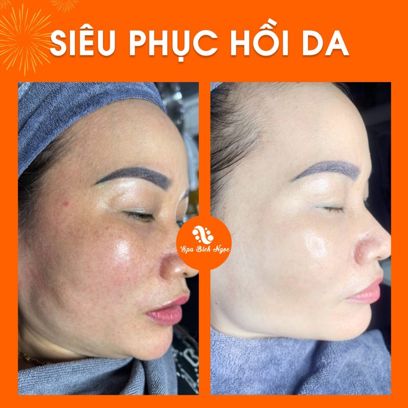 truoc-sau-spa-bich-ngoc