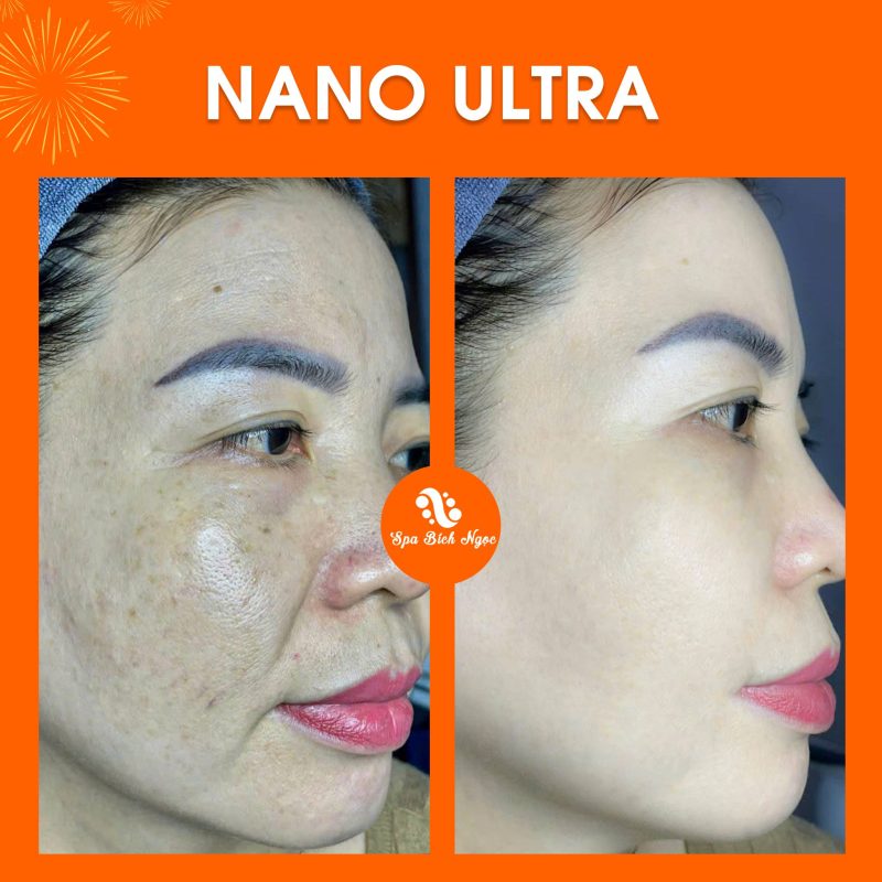 truoc-sau-spa-bich-ngoc
