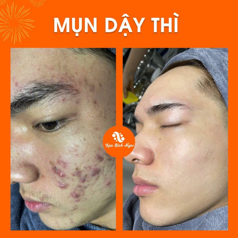 truoc-sau-spa-bich-ngoc