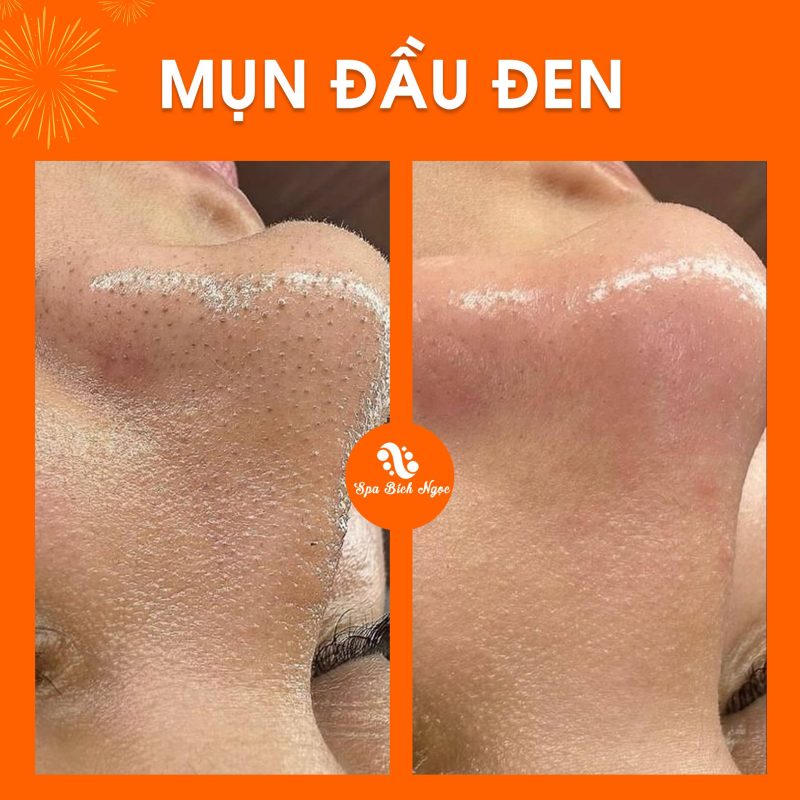 truoc-sau-spa-bich-ngoc