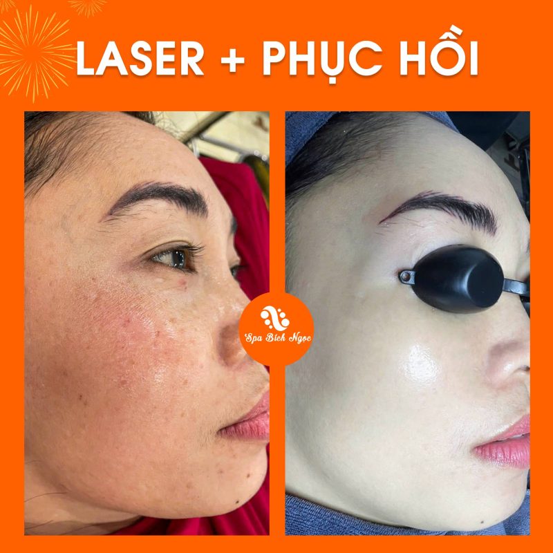 truoc-sau-spa-bich-ngoc