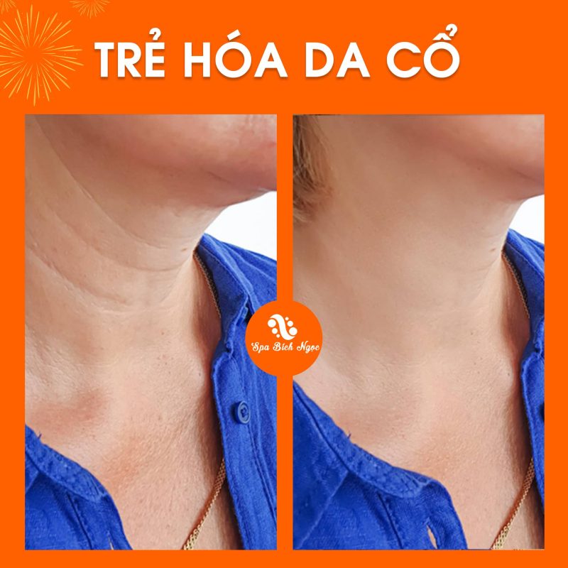 truoc-sau-spa-bich-ngoc