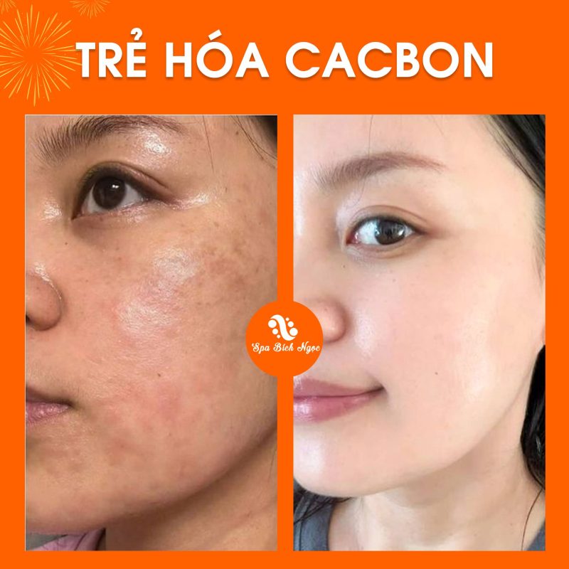 truoc-sau-spa-bich-ngoc
