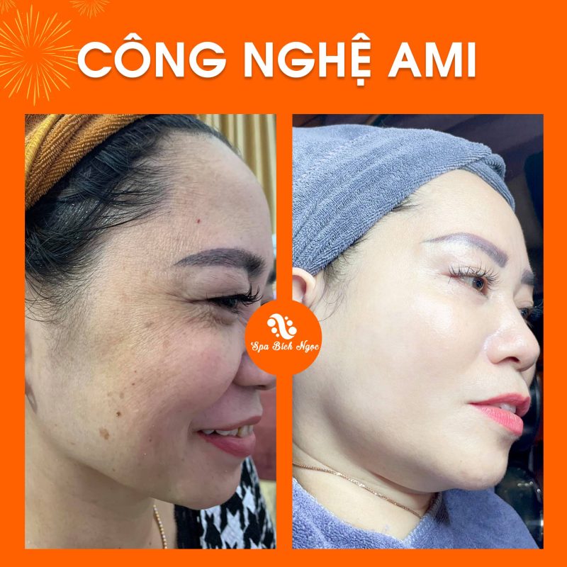 truoc-sau-spa-bich-ngoc