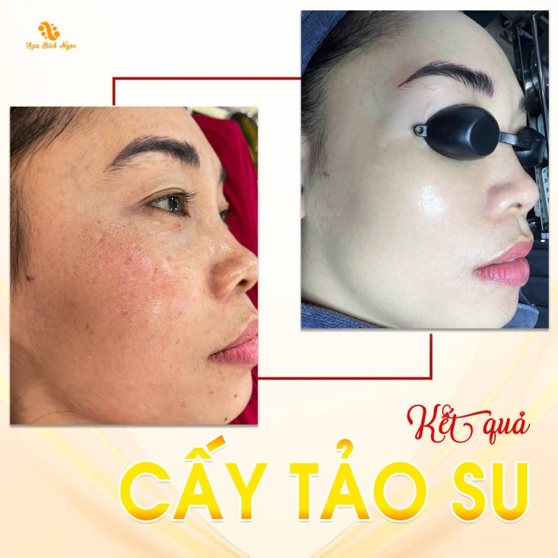 cay-tao-su-spa-bich-ngoc