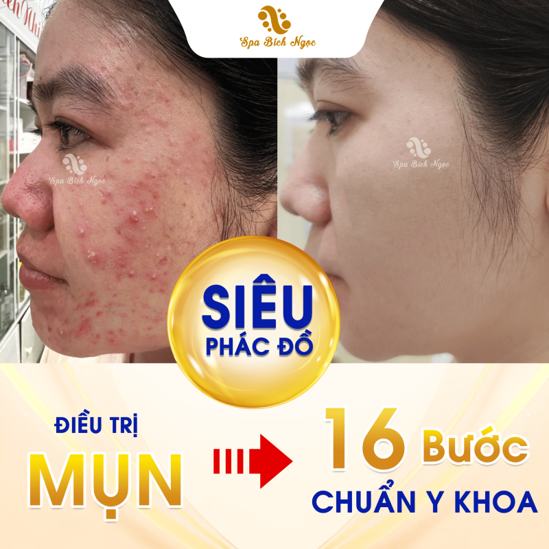 mun-spa-bich-ngoc-vinh-bao