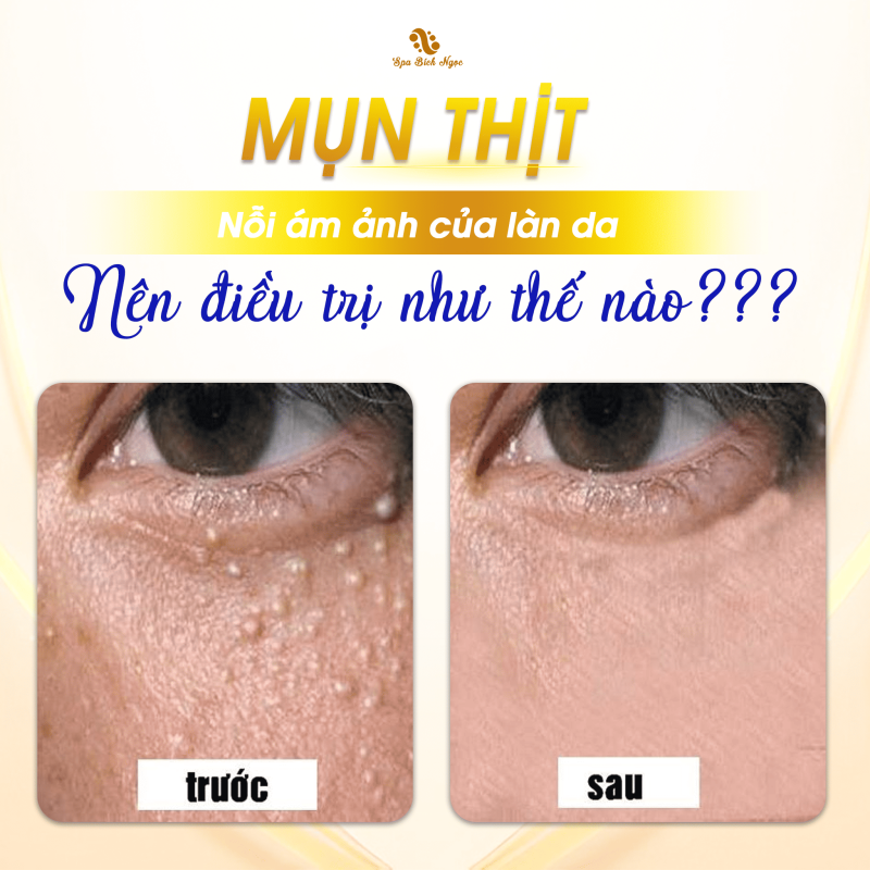 dot-mun-thit-spa-bich-ngoc